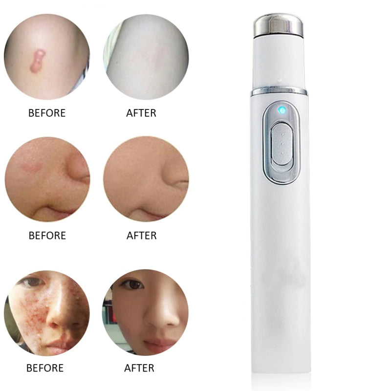 Laser Pen Portable Wrinkle Removal Machine - Emete Store